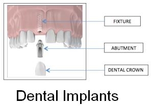 dental implants Bellevue Image