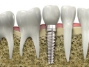 Dental implants Bellevue, WA Image