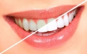 teeth whitening Bellevue Image