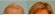 Female Hair Restoration