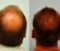 Crown Hair Transplant