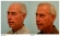 Male Hair Transplant