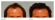 Asian Hair Transplant
