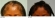 African Hair Transplant