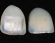 Lumineers and Veneers