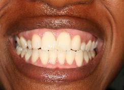Smile in the City Dental Group Now Offering Laser Treatment to Lighten Dark Gums