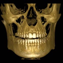 Oak Brook iCAT Offers a Cutting Edge Approach to Dental Implant Diagnosis and Treatment Planning