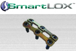 Captiva Spine Acquires Proprietary Cervical Plate System, SmartLox™