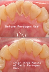 The Periogen Company Announces New Tartar-Dissolving Oral Rinse