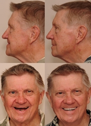 "Bite Collapse" Ages Baby Boomers, Reports Dr. Sam Muslin, DDS