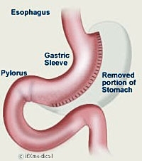 First Ever Endoluminal Bariatric Operation in South Asia is Performed in Chennai, India at Abscon 2012