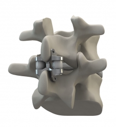 Eden Spine’s Proprietary Dynamic Interspinous Technology and Vertebral Body Replacement Receive Regulatory Approvals in Argentina