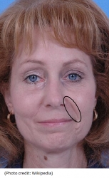 New: Aging Lines at Nose & Mouth ("nasolabial Folds") Can be Dramatically Improved