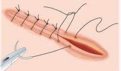 Phlebotomy Career Training One of the First Schools in the U.S. to Offer a Comprehensive Suturing Class to Medical Assistants