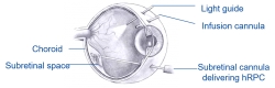 First Patients in Arizona Receive Experimental Stem Cell Treatment for Eye Disease