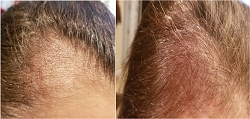 The Skin & Wellness Center is Now Offering Innovative Laser-Based Photobiomodulation Hair Regrowth Therapy