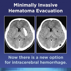 HCA Healthcare/HealthONE’s Swedish Medical Center First in Colorado to Offer Minimally Invasive Surgery to Remove Blood Clot from Brain