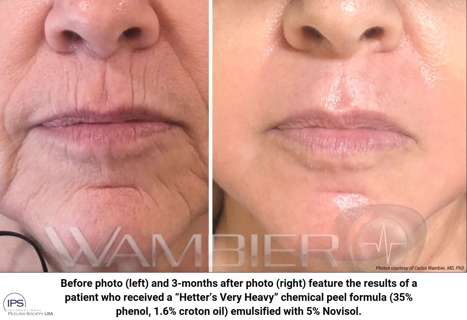 New Patent for Deep Chemical Peels Revealed at “Peeling Around the World” Educational Session