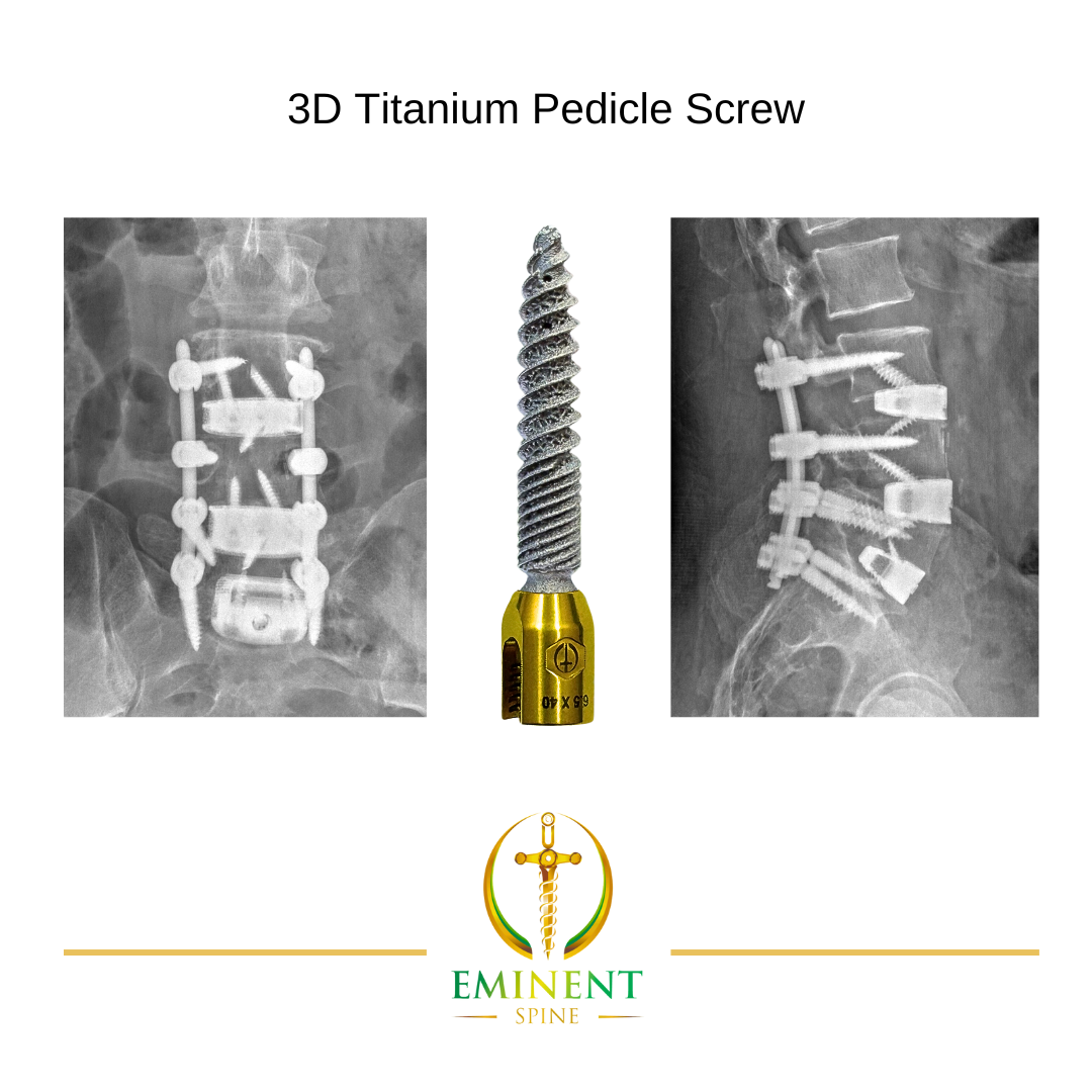Dr. Stephen Courtney Performs World’s First Procedure Using Eminent Spine’s Groundbreaking 3D-Printed Pedicle Screw