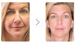 Beautiful Image Facial and Body Sculpting "The Lunch Time Face Lift" Gaining Popularity Across the Country