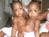 Makewell Helps Nigerian Family Find a Facility to Perform Rare Separation Surgery for Conjoined Twins