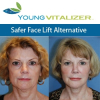 Award Winning Beauty Theorist and Facial Plastic Surgeon Dr. Philip Young Announces the Development of the YoungVitalizer, a New Incision-Less Face Lift Alternative