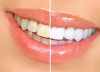 Dental Check Ups Suggested Prior to Teeth Whitening