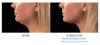 Cool Mini Now FDA Approved to Freeze Off a Double Chin Offered at Yolo Laser Center & Med Spa