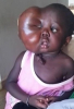 Dr. Michael K. Obeng Will Perform a Miraculous Surgery on Sarjo Trawally, a 4-Year-Old Girl from Gambia with a Life Threatening Facial Cystic Hygroma