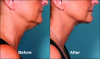 KYBELLA® Under Chin Fat Reduction @ Wymore Laser & Anti-Aging Center in Winter Park, FL