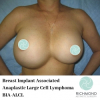Survivors Ask FDA to Ban Textured Breast Implants Due to Rare Cancer Link; Dr. Neil J. Zemmel, Richmond Aesthetic Surgery, Respected Plastic Surgeon Agrees
