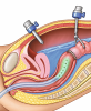 Endolumik Expands Gastrointestinal Calibration Tube Into Colorectal Surgery, Broadening Its FDA-Registered Platform