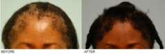 African Hair Transplant