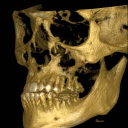 3D Rendering of Bone and Teeth