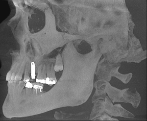 A Cephalometric View of an Implant Patient