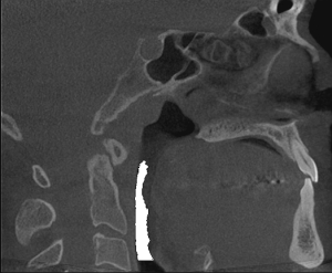 Airway Evaluation from an i-CAT CT Scan