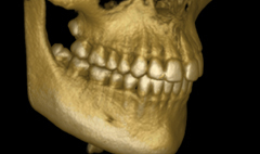 Wisdom Teeth in 3D