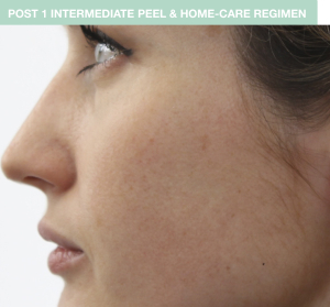 Skin after one Chemical peel: Replenix MD Perfect 10 Peel
