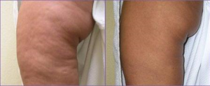 Skin Tightening & Cellulite Reduction for the Body