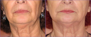 Skin Tightening for the Face, Jowls & Neck