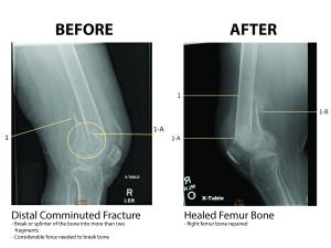 Before and After X-Ray of Comminuted Femur Fracture