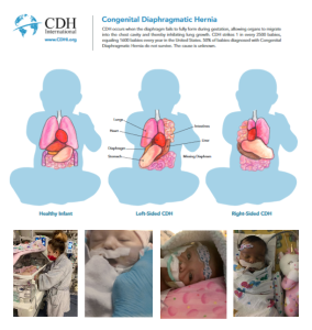 Anatomy of Congenital Diaphragmatic Hernia