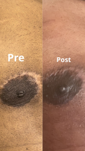 Pre & 1 week post Gynecomastia Scars