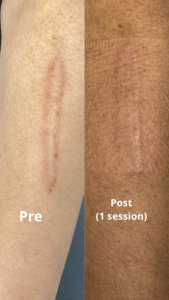 Pre & Post Initial Session Burn Scar