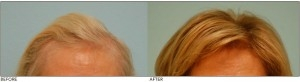 Female Hair Restoration