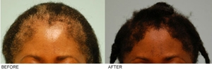 African Hair Transplant